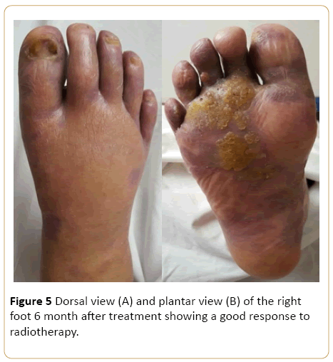 Localized Kaposi Sarcoma | Insight Medical Publishing