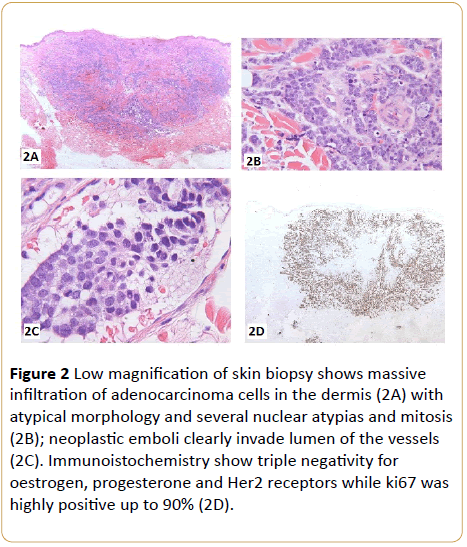 Rapidly Fatal Pseudo Gumma as First Presentation of Breast Cancer ...